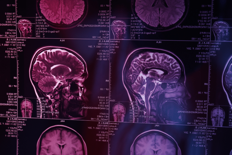 MRI Results