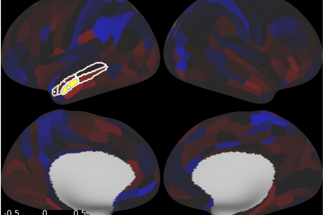 brain scan of patient with dimentia prior to treatment