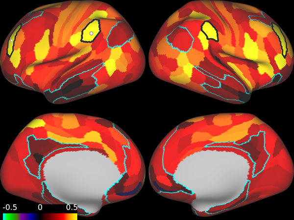 Brain Images Before TMS Therapy Treatment