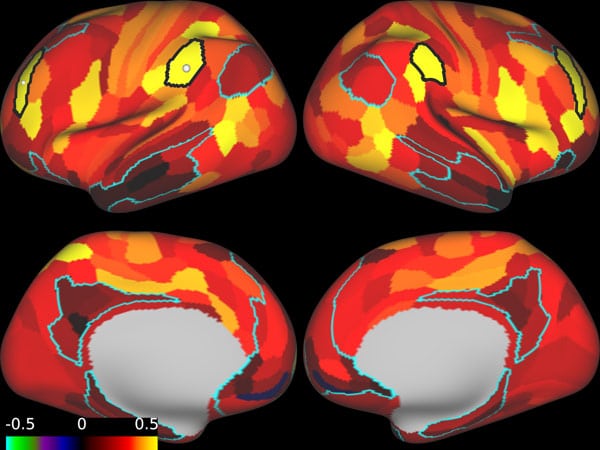 Brain Images Before TMS Therapy Treatment