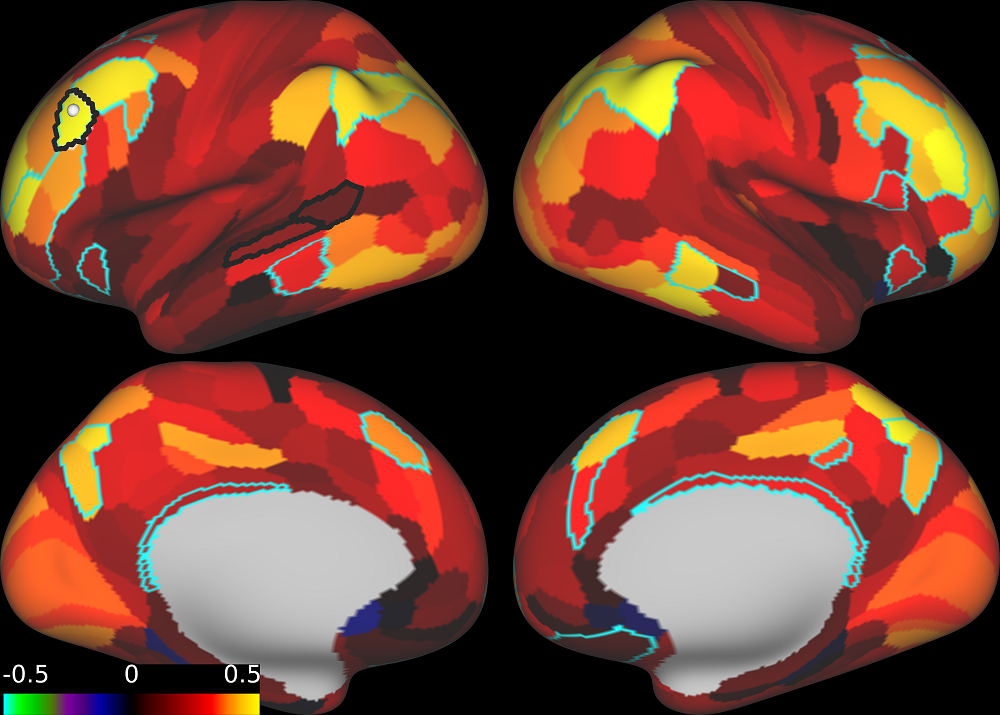 Normalized fronto-temporal connectivity in the same patient with risk factors for neurodegenerative diseases after treatment