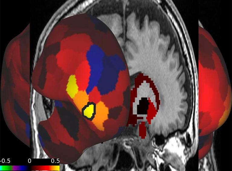 Decreased fronto-caudate connectivity in a patient with anorexia nervosa