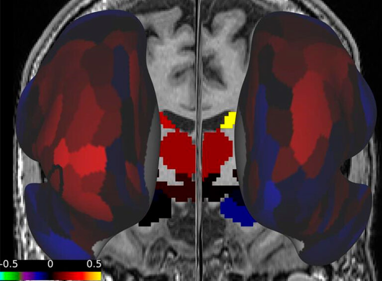 Decreased fronto-caudate connectivity in a patient with anorexia nervosa (subcortico-cortical view)