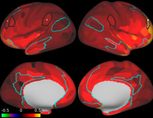 Decreased prefrontal connectivity in a patient with PTSD