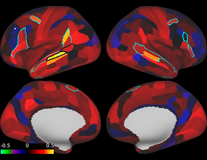 Decreased temporo-frontal connectivity in a patient with risk factors for neurodegenerative diseases prior to treatment