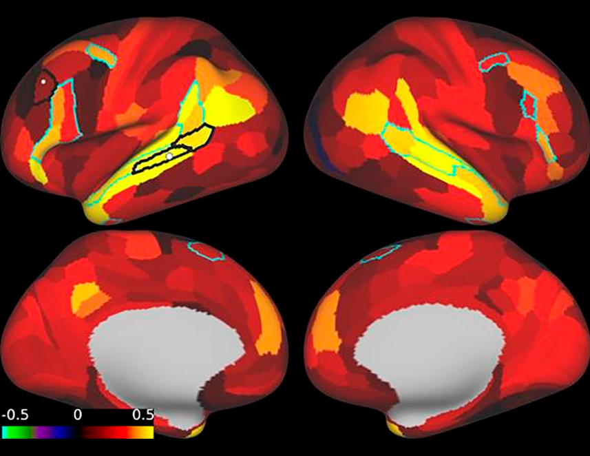 Normalized temporo-frontal connectivity in the same patient with risk factors for neurodegenerative diseases after treatment