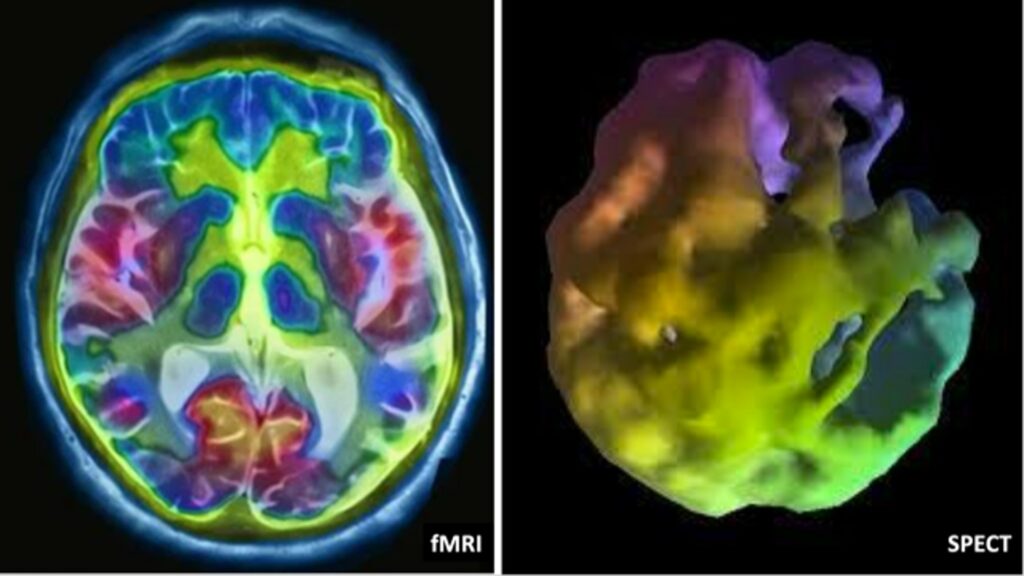 fMRI vs. SPECT Scan for the Brain