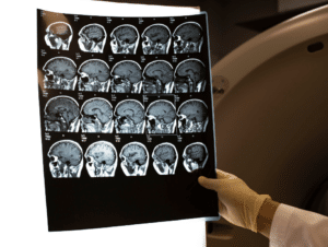 TBI Brain Scan