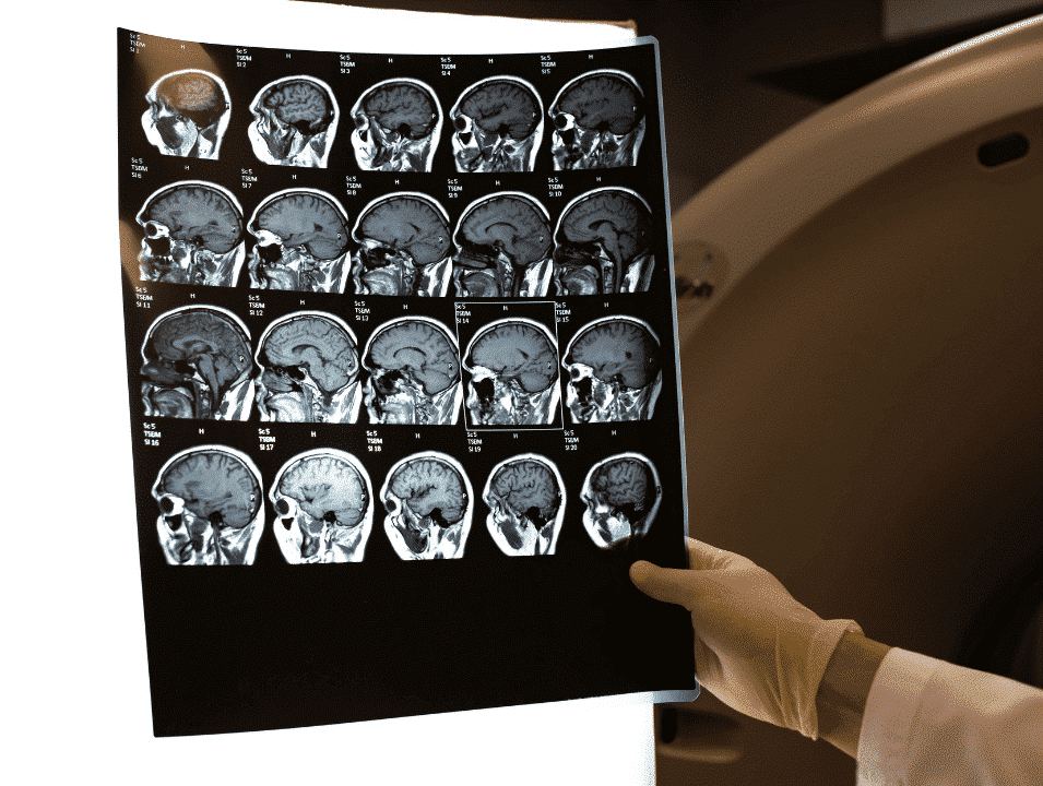 TMS Therapy for Fibromyalgia in - MRI Brain Scan TBI 2 1 1 1 