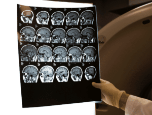 TBI Brain Scan