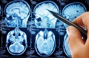 Set of brain scans